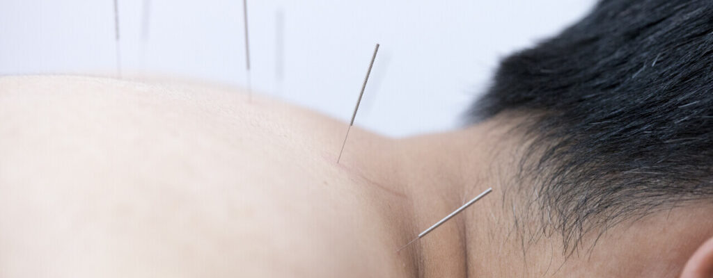 Find Effective Relief for Your Pain with Acupuncture